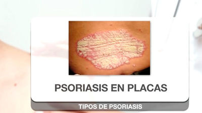 Psoriasis, una enfermedad en la que duele algo más que la piel