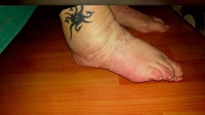 Sudek, el síndrome del dolor extremo