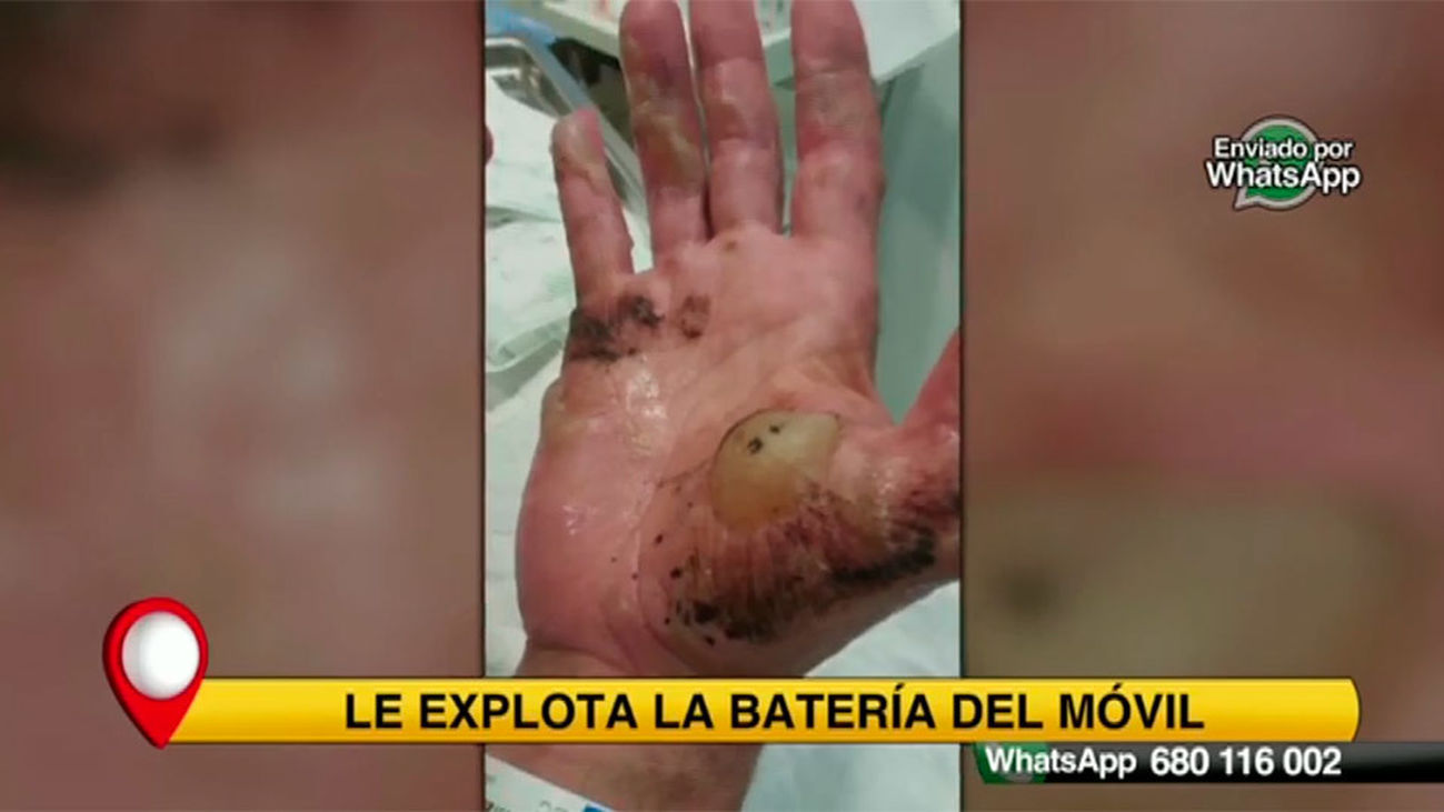 Le explota la batería del móvil y le produce quemaduras de segundo grado