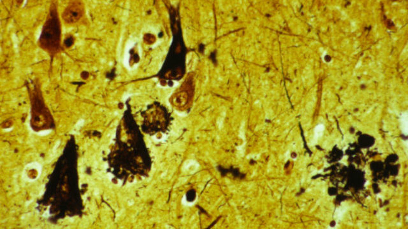 Imagen del cortex cerebral de un paciente con Alzheimer