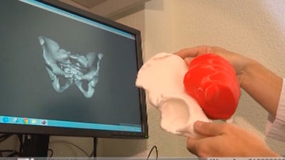 Impresoras 3D para cirugías más precisas y más cortas