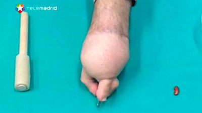 Trasplantan a su mano tres dedos de los pies