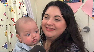 Vall d'Hebron aplica una nueva técnica para moldear el labio leporino