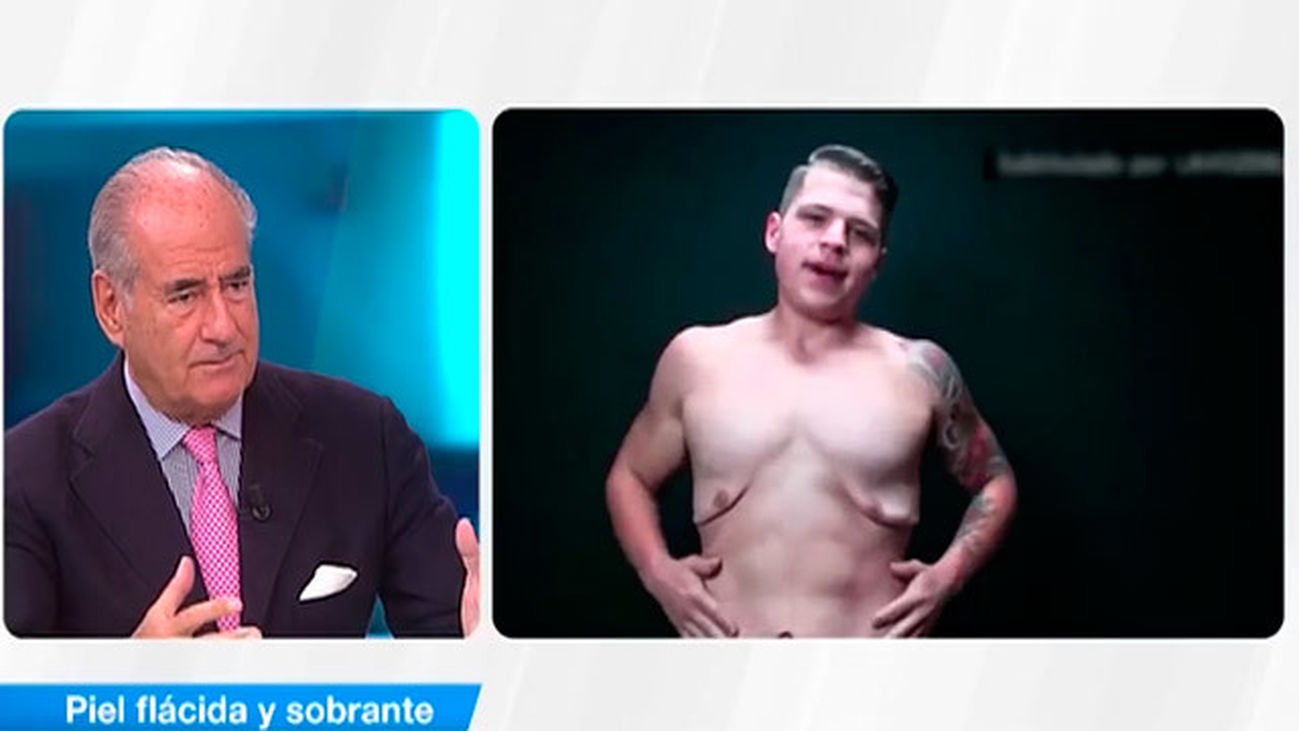 ¿Qué hacer con la piel flácida y sobrante?