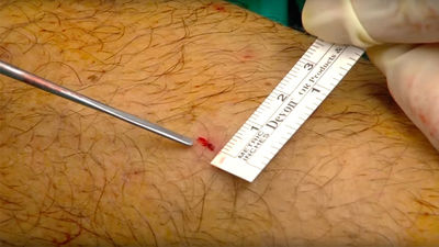 Cirugía ecoguiada ¿el futuro de la medicina deportiva?