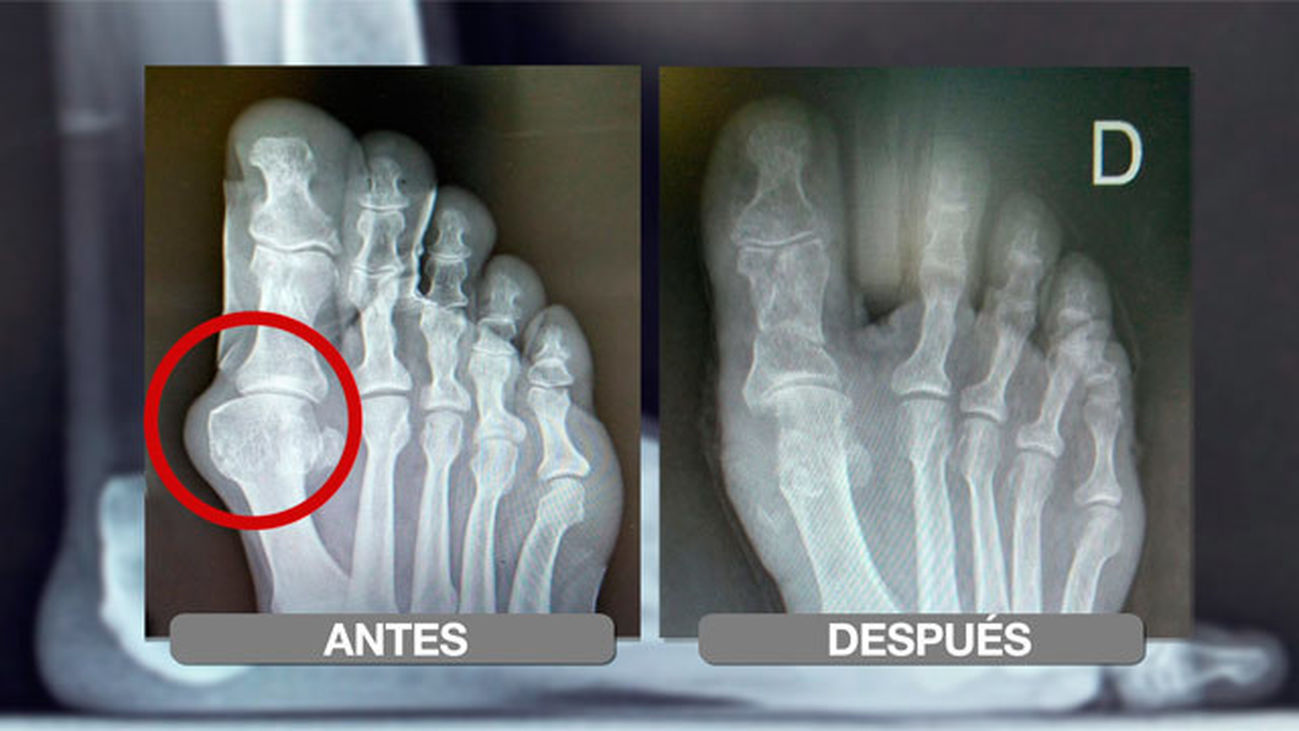 Cómo prevenir y eliminar los juanetes