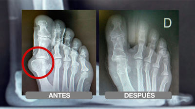 Cómo prevenir y eliminar los juanetes