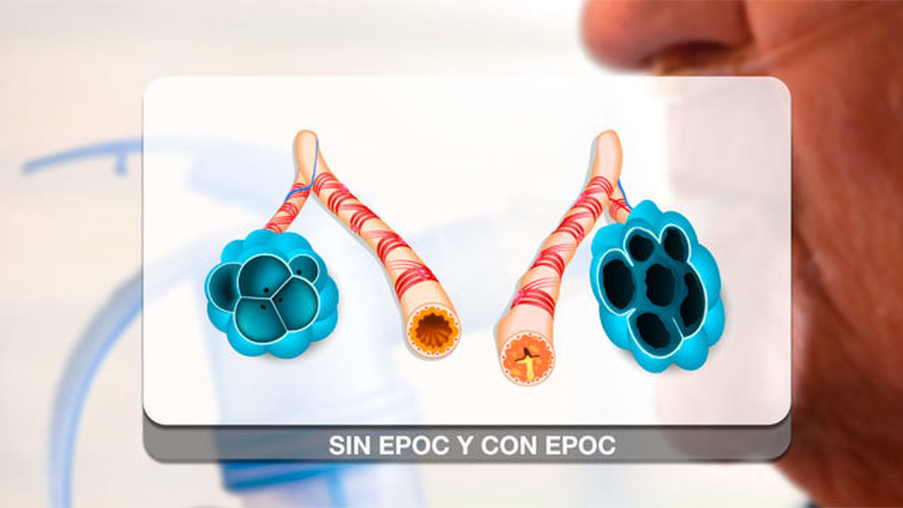 EPOC: qué es y su tratamiento