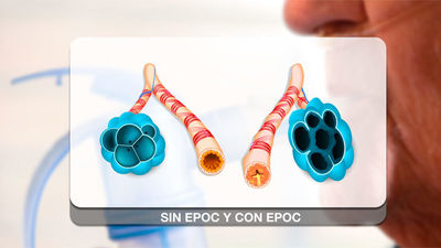 EPOC: qué es y su tratamiento