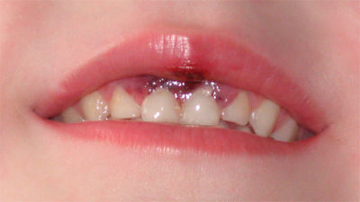 Cómo actuar con los niños ante un golpe en la cabeza o un diente roto