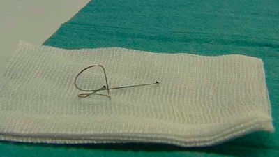 La Fundación Jiménez Díaz implanta muelles pulmonares contra el  enfisema pulmonar