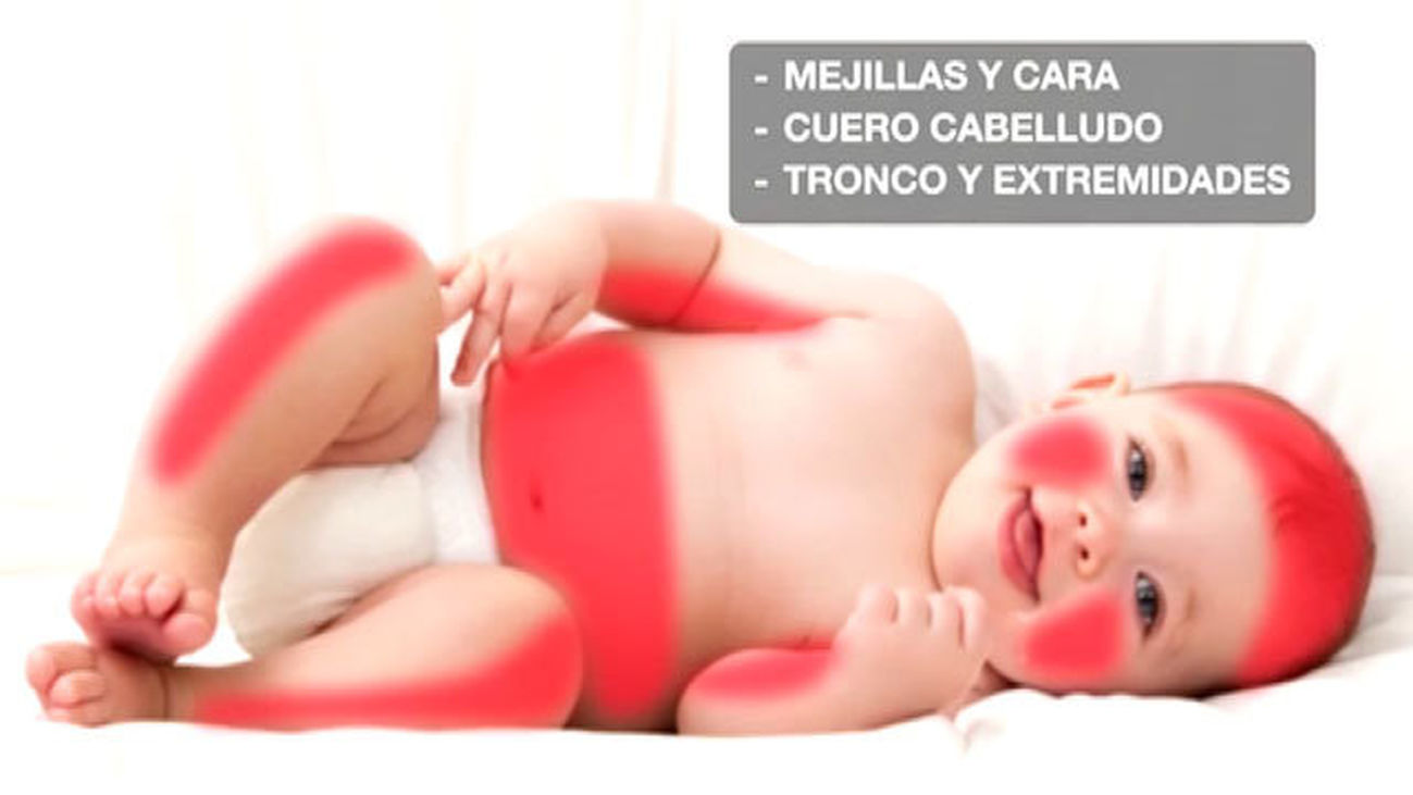 La dermatitis atópica