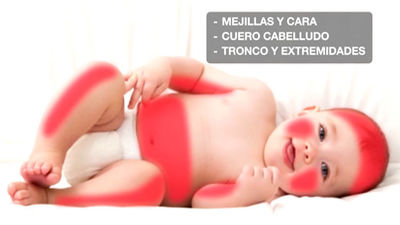 La dermatitis atópica