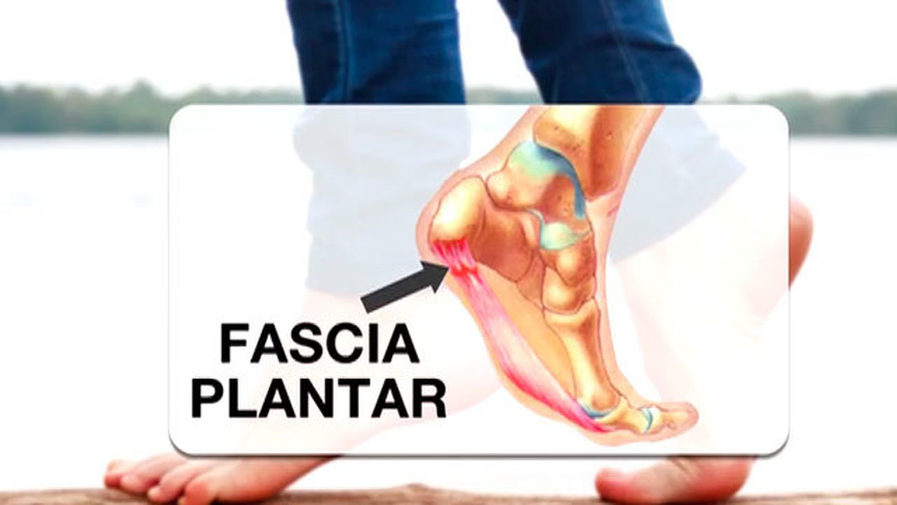 La lesión más temida, la fascitis plantar