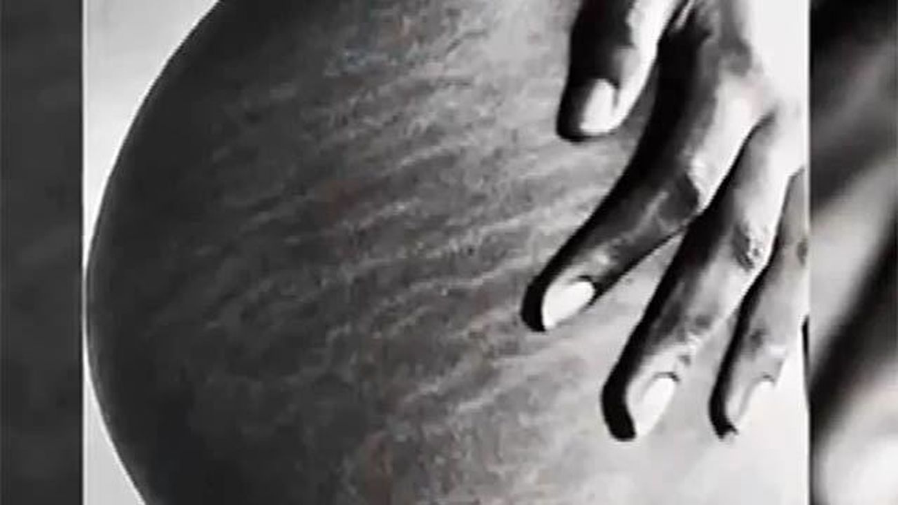 Estrías: qué son, cómo se forman y cómo tratarlas