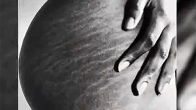 Estrías: qué son, cómo se forman y cómo tratarlas