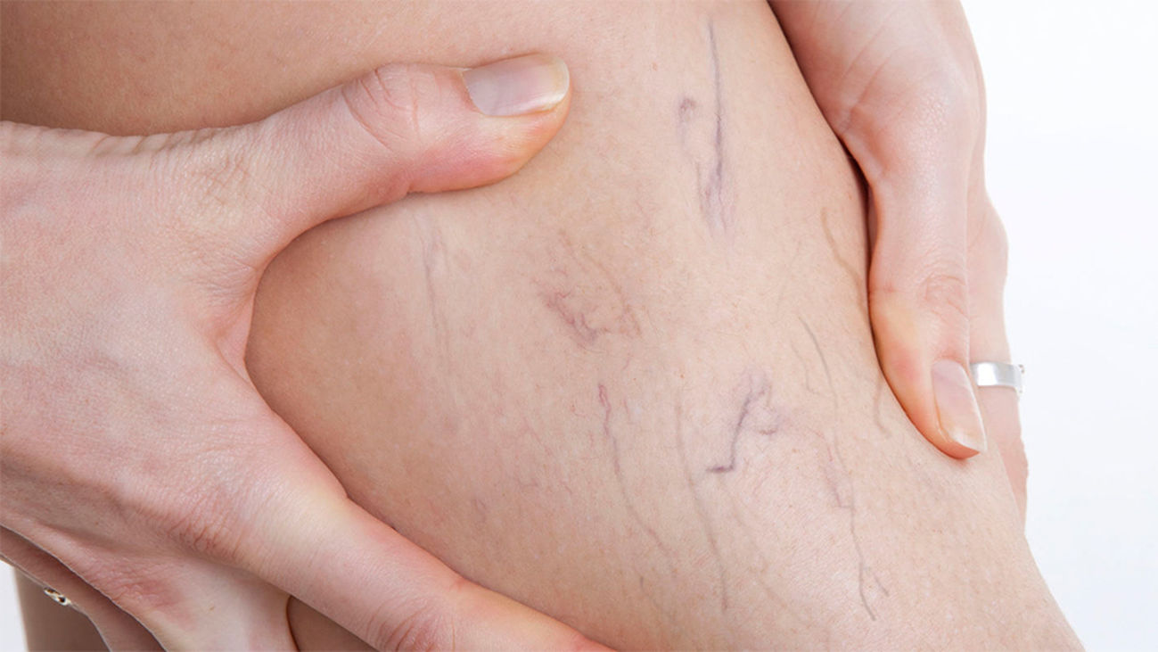 Varices: lo llevas en los genes