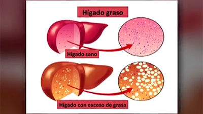 Qué es el hígado graso