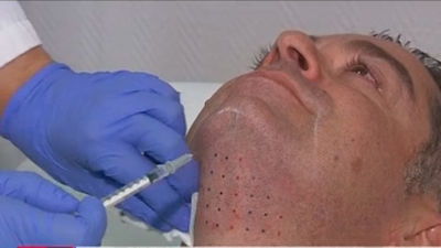 Quitar la papada ya es posible sin pasar por el quirófano