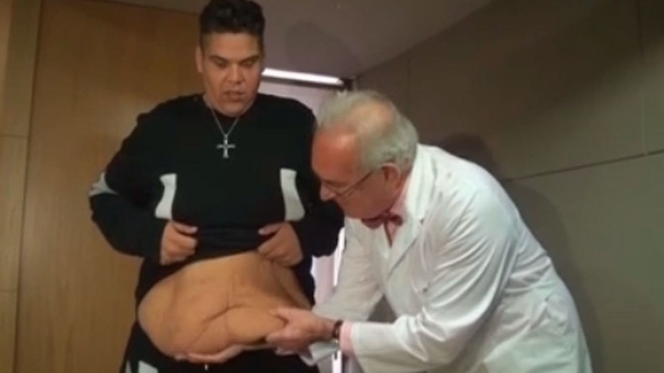 El hombre más obeso se operará para eliminar piel tras perder 180 kilos