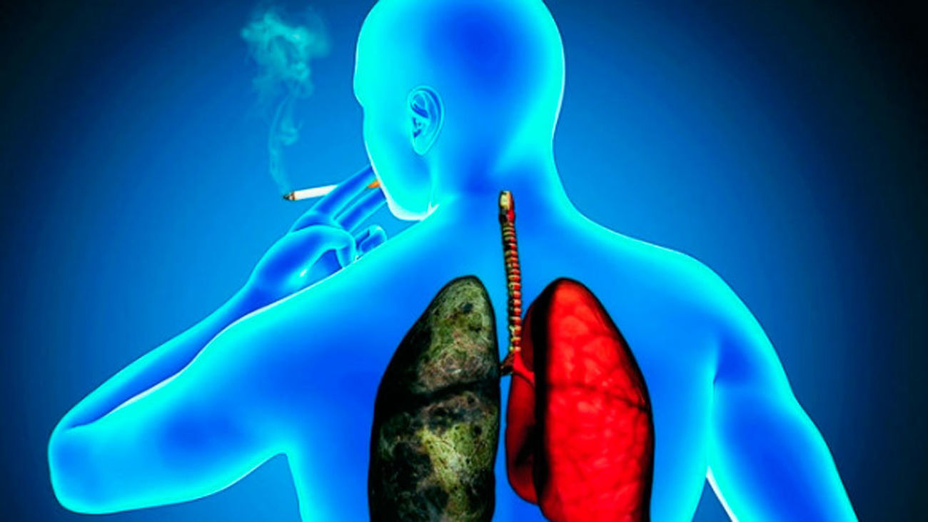 Los expertos advierten del aumento del número de mujeres con cáncer de pulmón