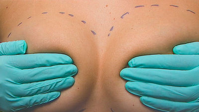 Cirugía estética: Los implantes mamarios