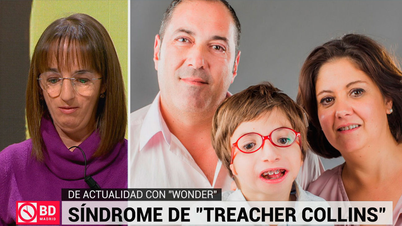 El síndrome de "Treacher Collins", visible gracias a la película Wonder