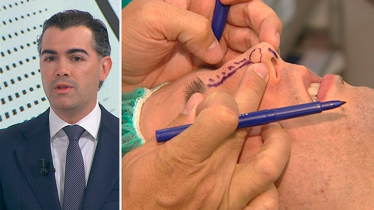 Rinoplastia, algo más que simple estética