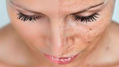 Manchas en la piel a los 40, ¿qué hacer?