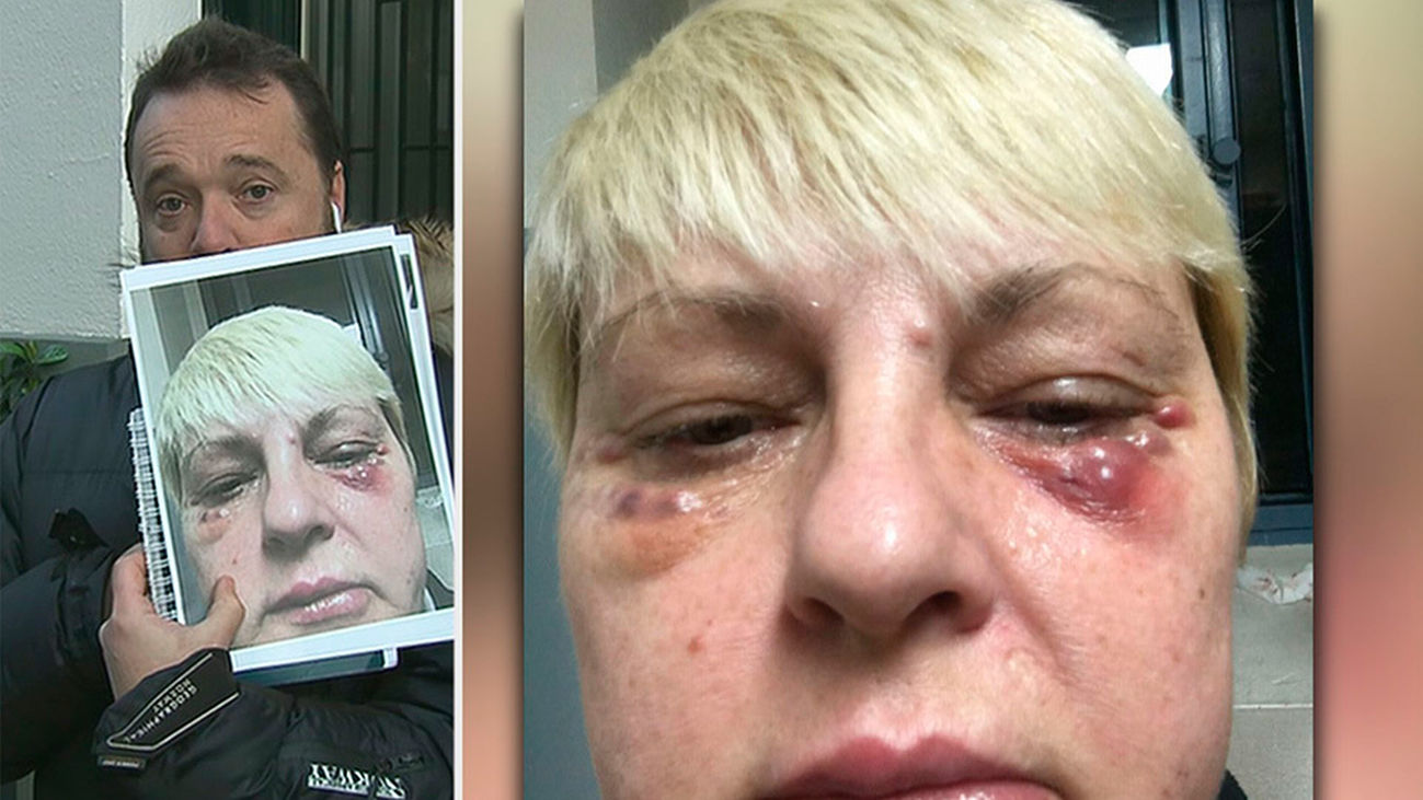 Va a quitarse las ojeras y le dejan la cara desfigurada