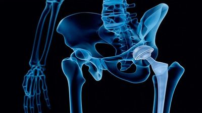Cómo se implanta una prótesis de cadera y cuál es el tiempo de recuperación