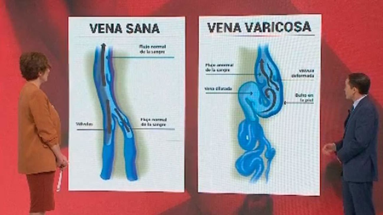 ¿Cómo se puede retrasar la aparición de las varices?