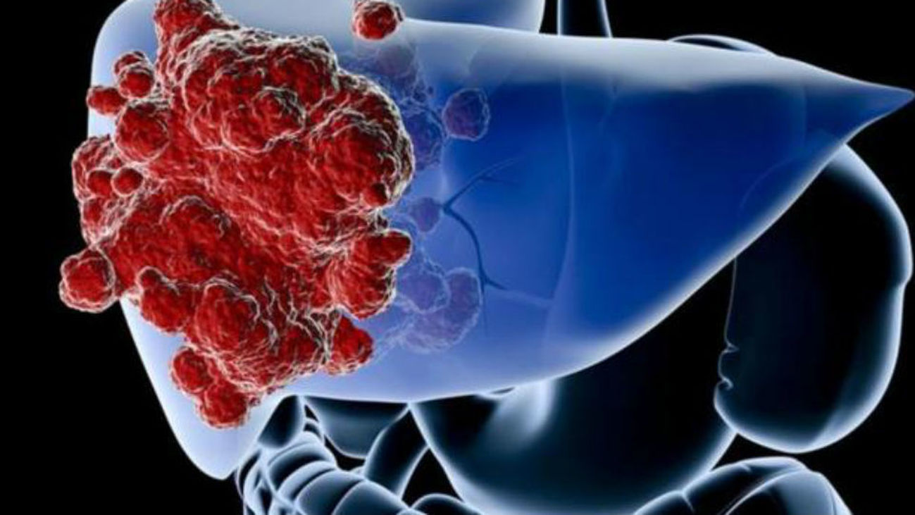 Descubren una nueva proteína para luchar con el cáncer de hígado