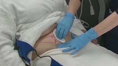 ¿Cómo acabar con la celulitis?