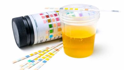 La cistitis es la infección más común en las mujeres