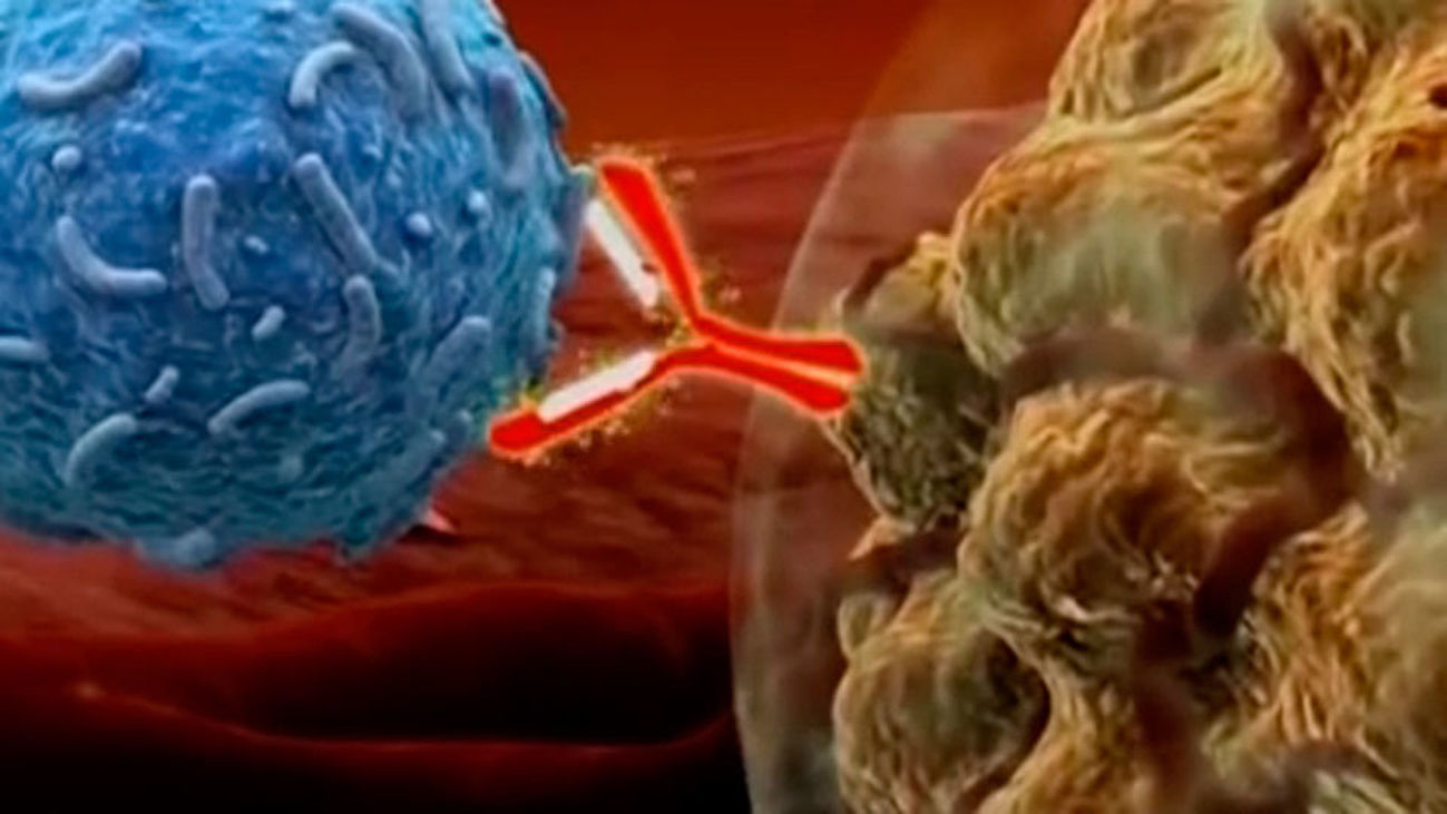 La inmunoterapia consigue por primera vez eliminar un cáncer de mama