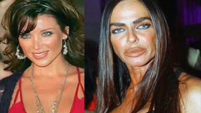 Desastres de la cirugía estética