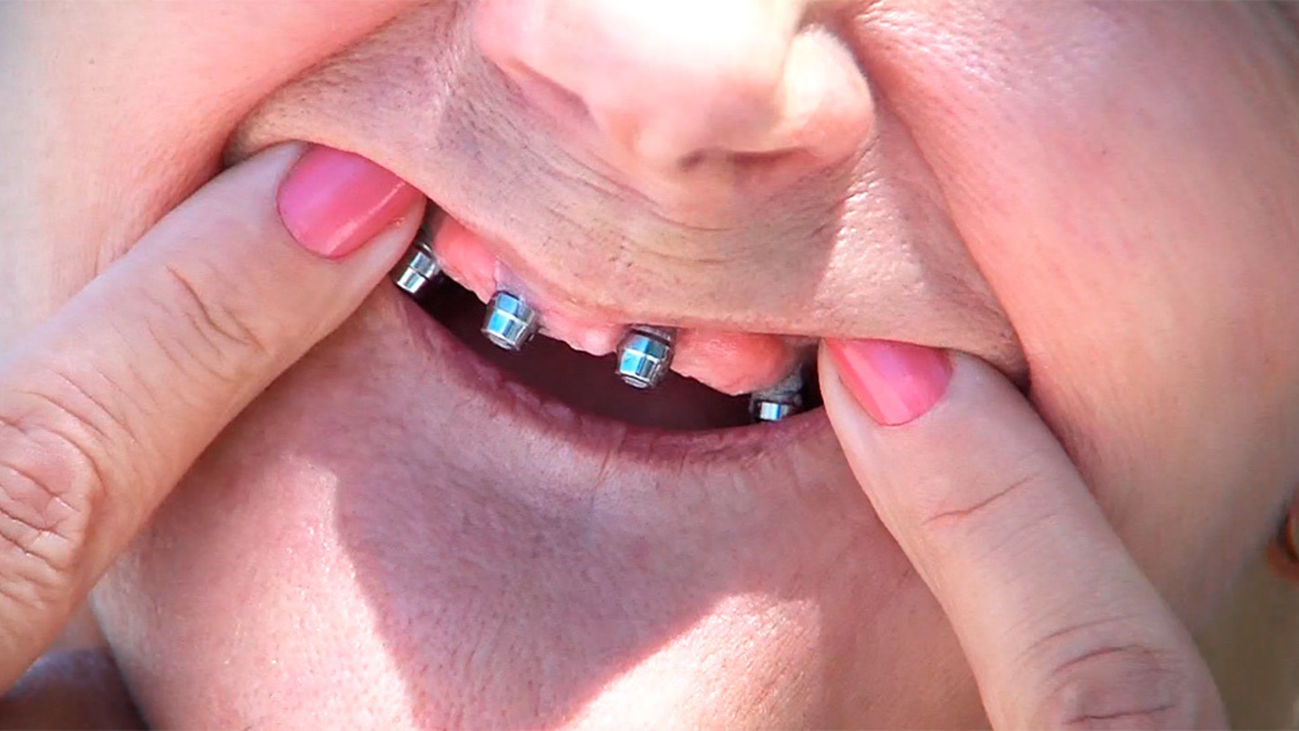 Sin dientes y sin dinero: el drama de los estafados por iDental