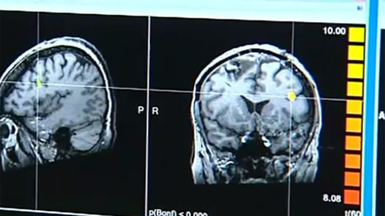 El Ictus, una enfermedad que causa en España la muerte o una discapacidad a unas 80.000 personas al año