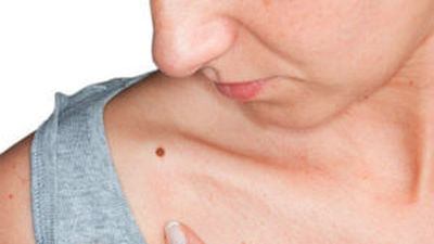 Descubren un marcador que predice cuándo un cáncer de piel causará metástasis