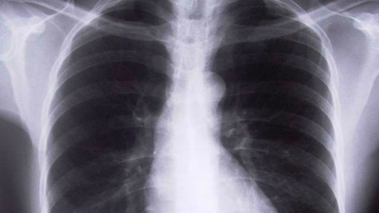 El carcinoma de pulmón, el tipo de cáncer que más muertes causa en el mundo, tiene los días contados