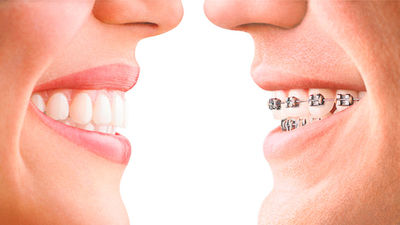 Brackets, ¿una cuestión de salud o simple moda estética?