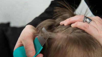 ¿Tienen solución los piojos?