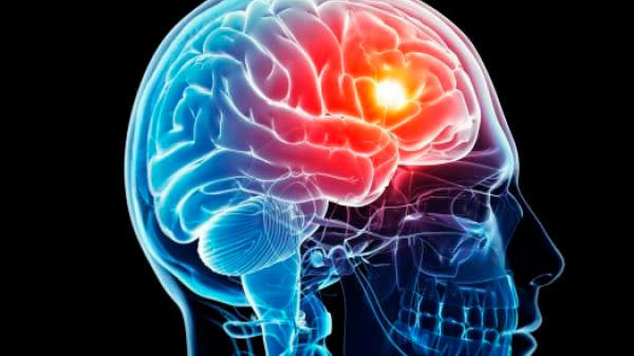 El plan de atención del Ictus de la Comunidad de Madrid, 10 años después