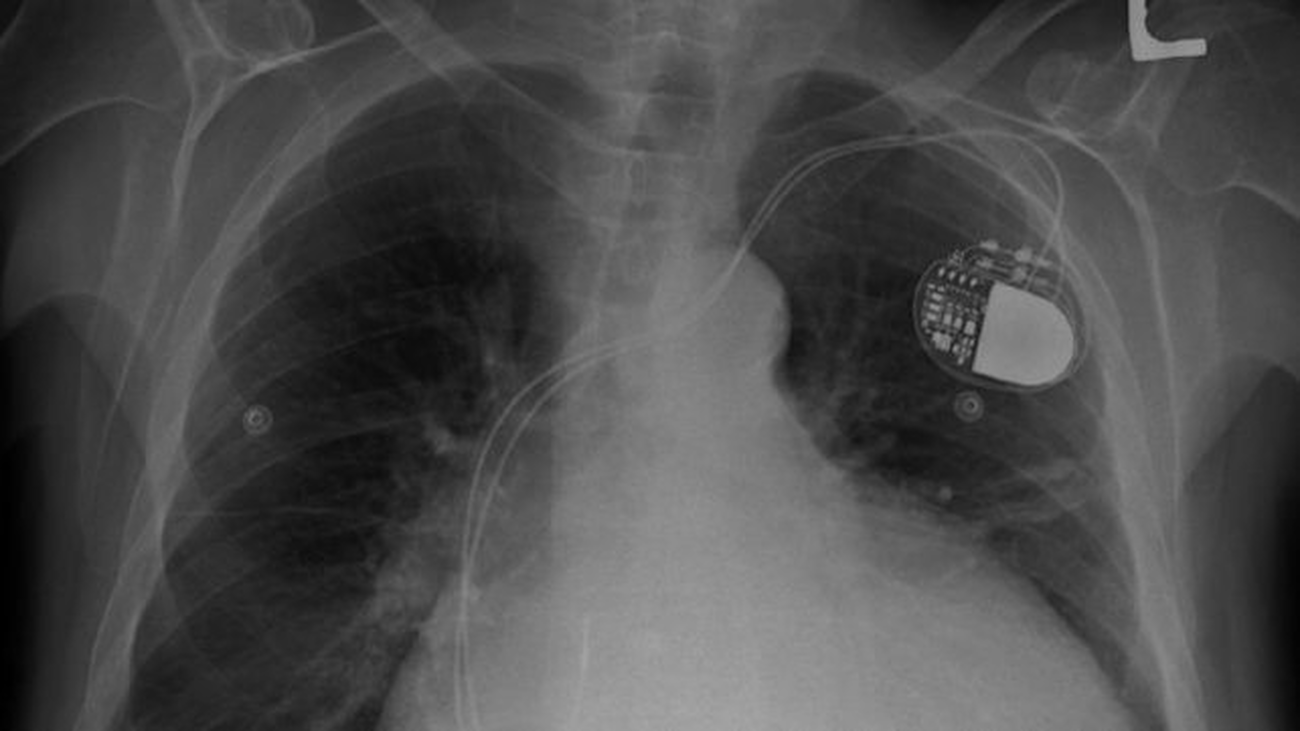 El fraude mundial con implantes médicos que afecta a millones de pacientes