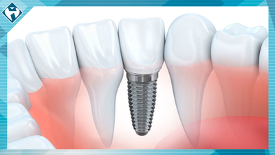 El implante dental: el sustituto artificial de los dientes