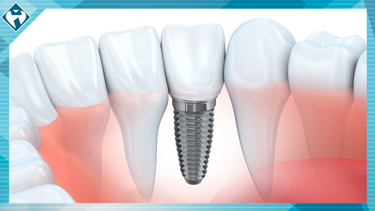 El implante dental: el sustituto artificial de los dientes