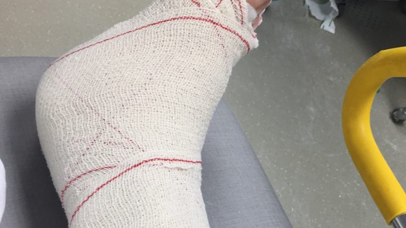 Carmena pasa por quirófano por su rotura de tobillo