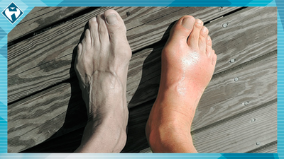 Gota, la enfermedad reumática que “ataca” de noche