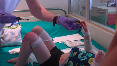 La fragilidad de vivir con Piel de Mariposa